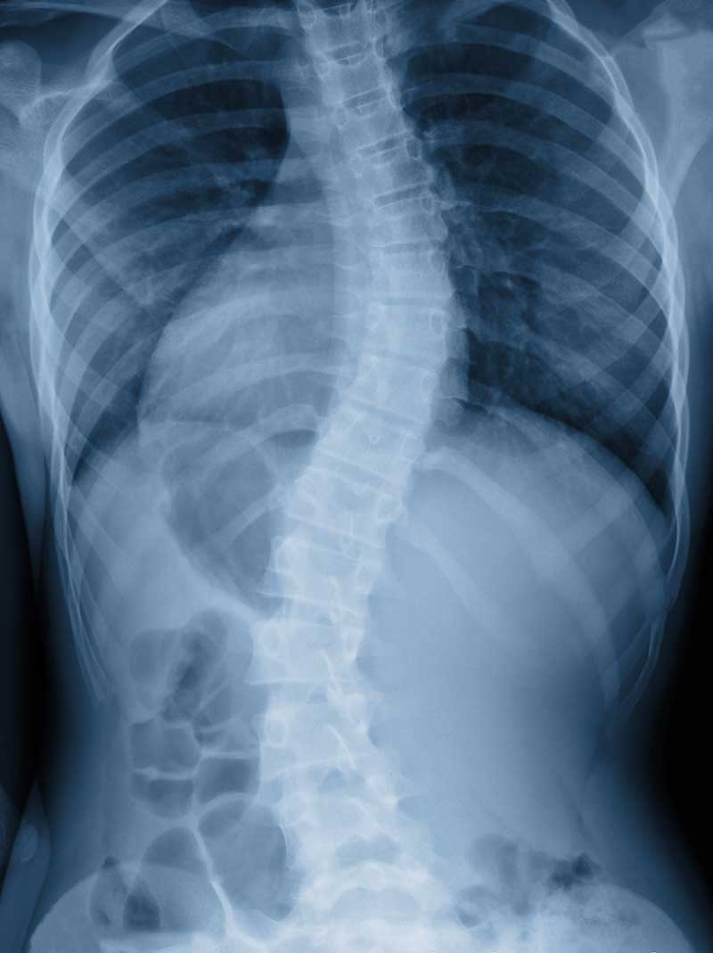 Scoliosis Troy, NY,
